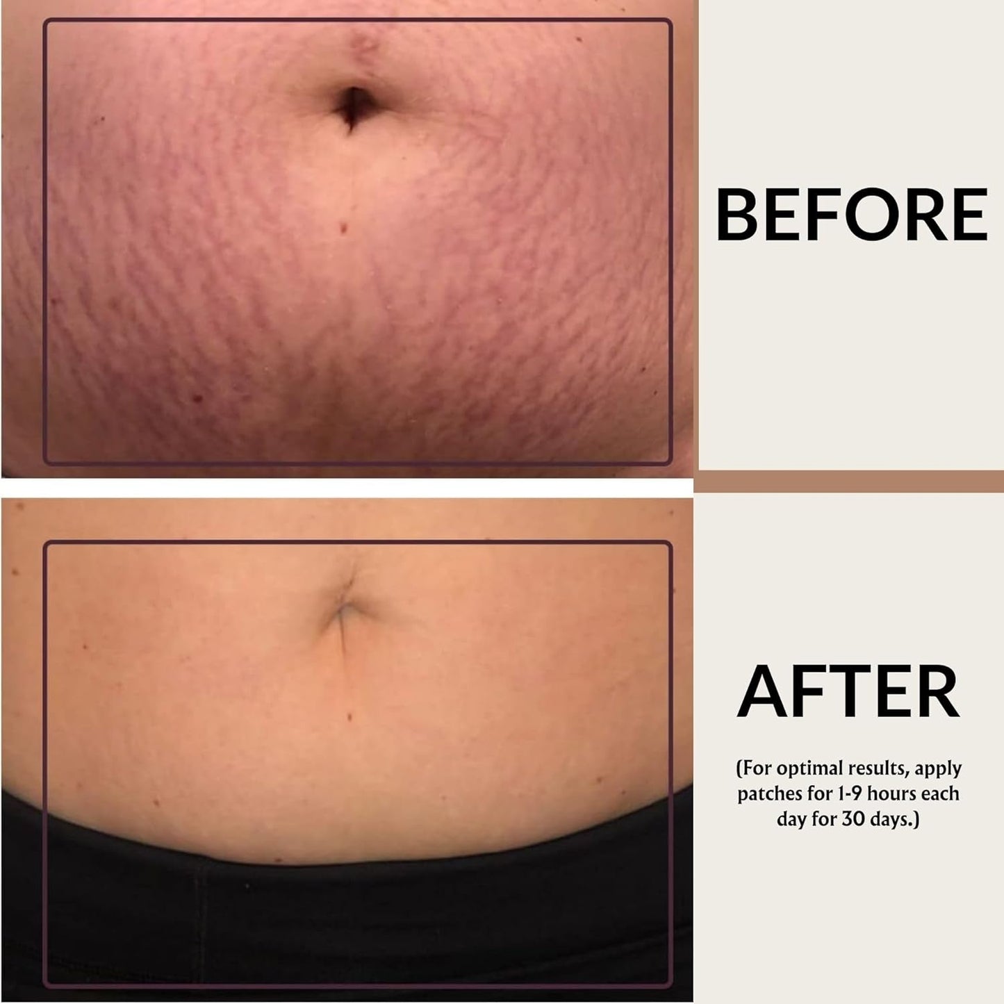 Enhanced Silicone Fusion Body Patch - Silicone Patches For Scars - Prevent and Treat Stretch Marks